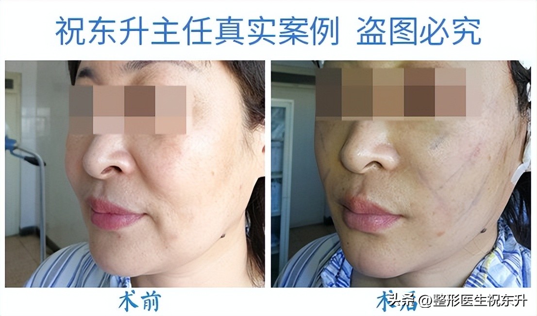 嘴角木偶纹做拉皮手术可以消除吗,做拉皮手术口角纹怎么没去掉