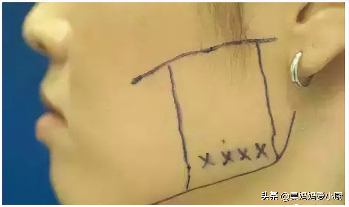 咬肌大到影响脸型怎么办,咬肌大对颧骨的影响