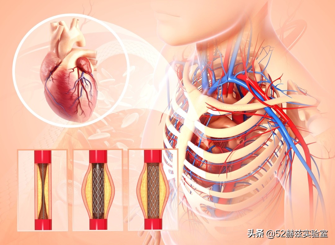 从13000元骤降至700元！看国产心脏支架如何吊打国外？