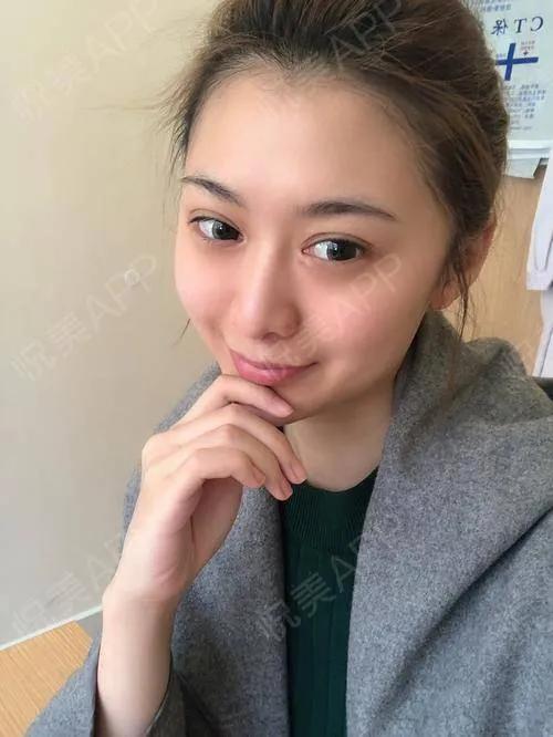 小孩慢慢从单眼皮变成双眼皮,小孩一生病就变双眼皮怎么回事