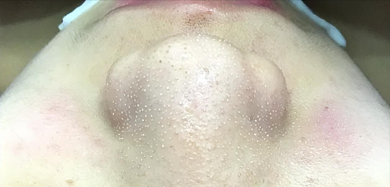 鼻子黑头里挤出的白色油脂怎么办,鼻子上有硬硬的黑头怎么办