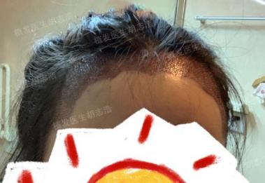 植发后后枕部的头发多久能恢复,植发3个月恢复图片