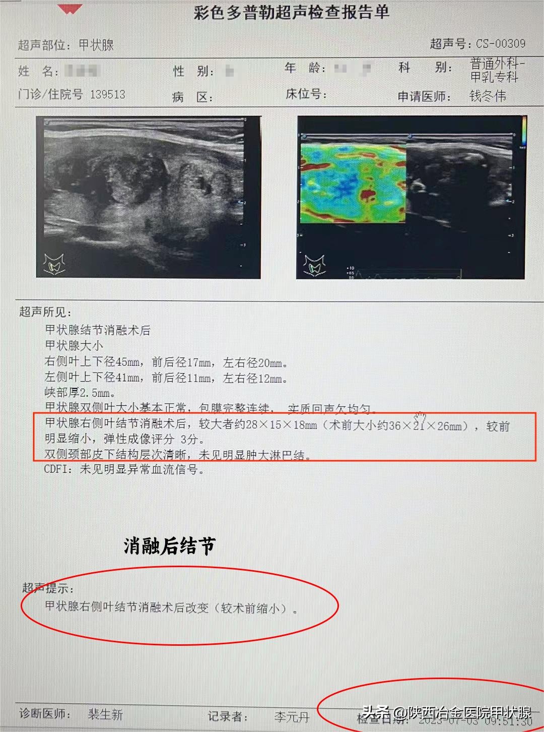 目前消融甲状腺结节手术效果怎样,甲状腺结节消融术后康复效果