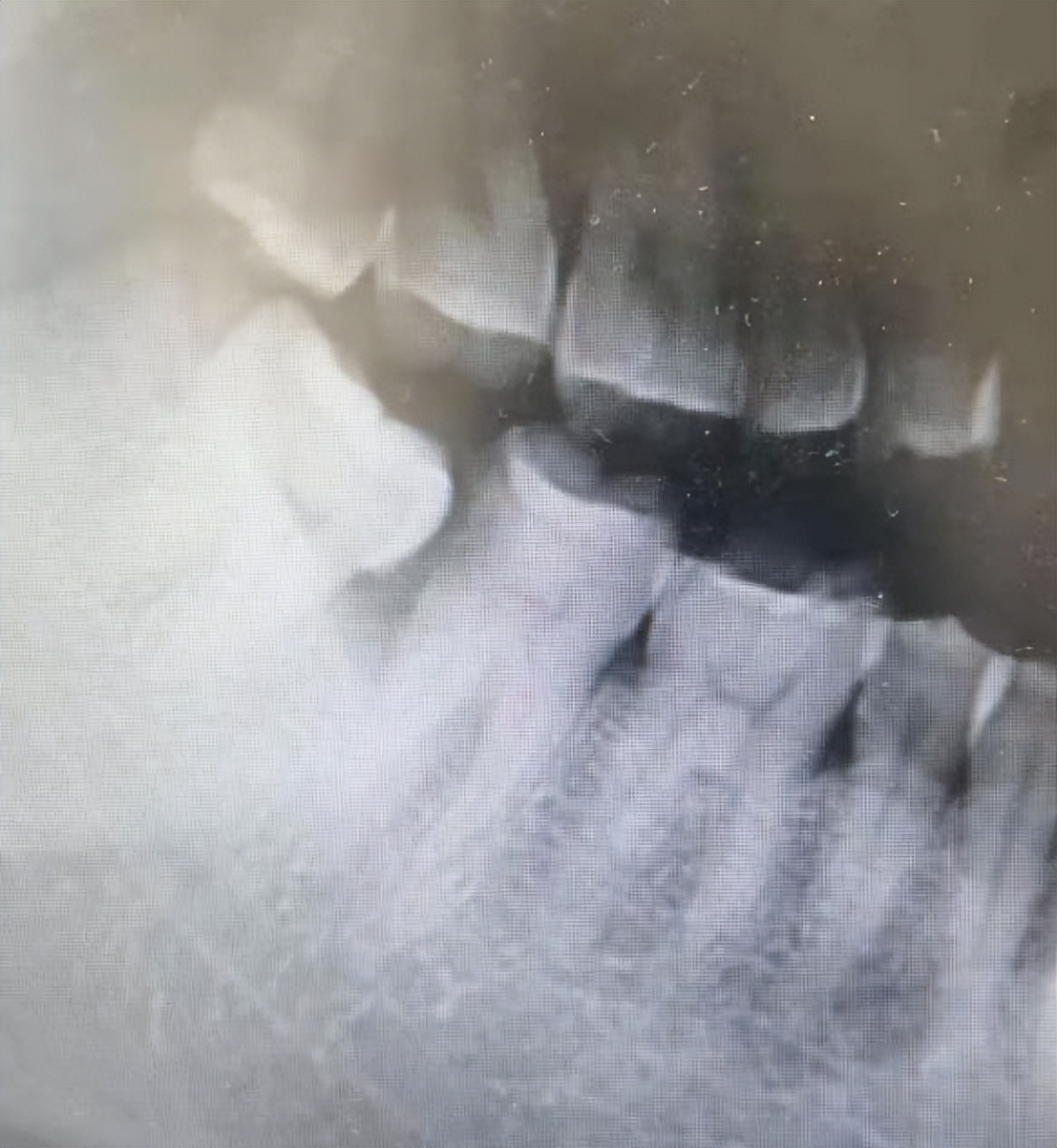 牙髓炎疼的快速止痛方法,牙髓炎疼痛怎么办速效方法