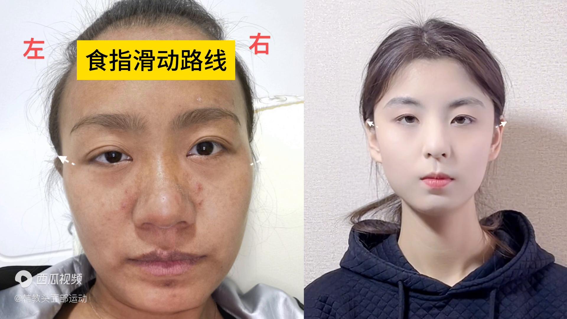 大小脸颧骨一边高一边低矫正,大小脸纠正颧骨突出