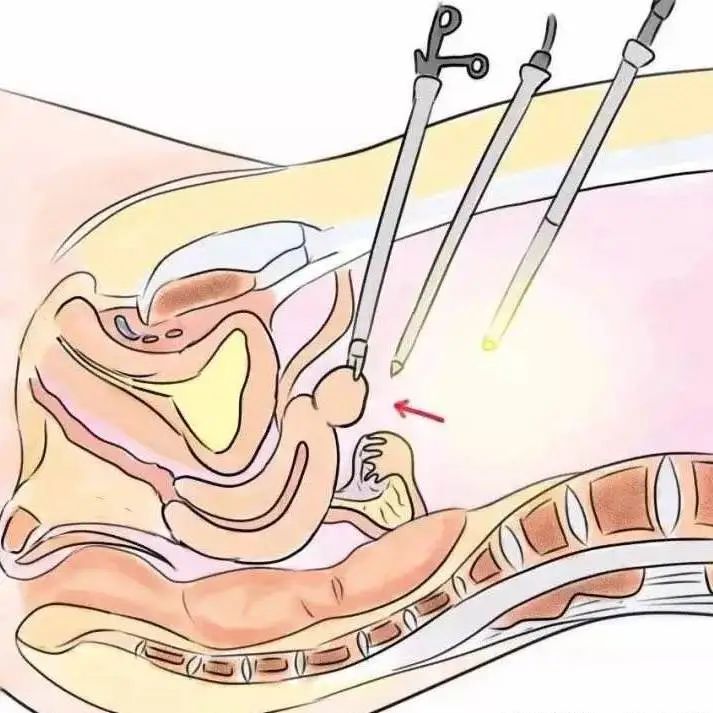 这种方式的腹腔镜手术，真正实现腹部“零瘢痕”