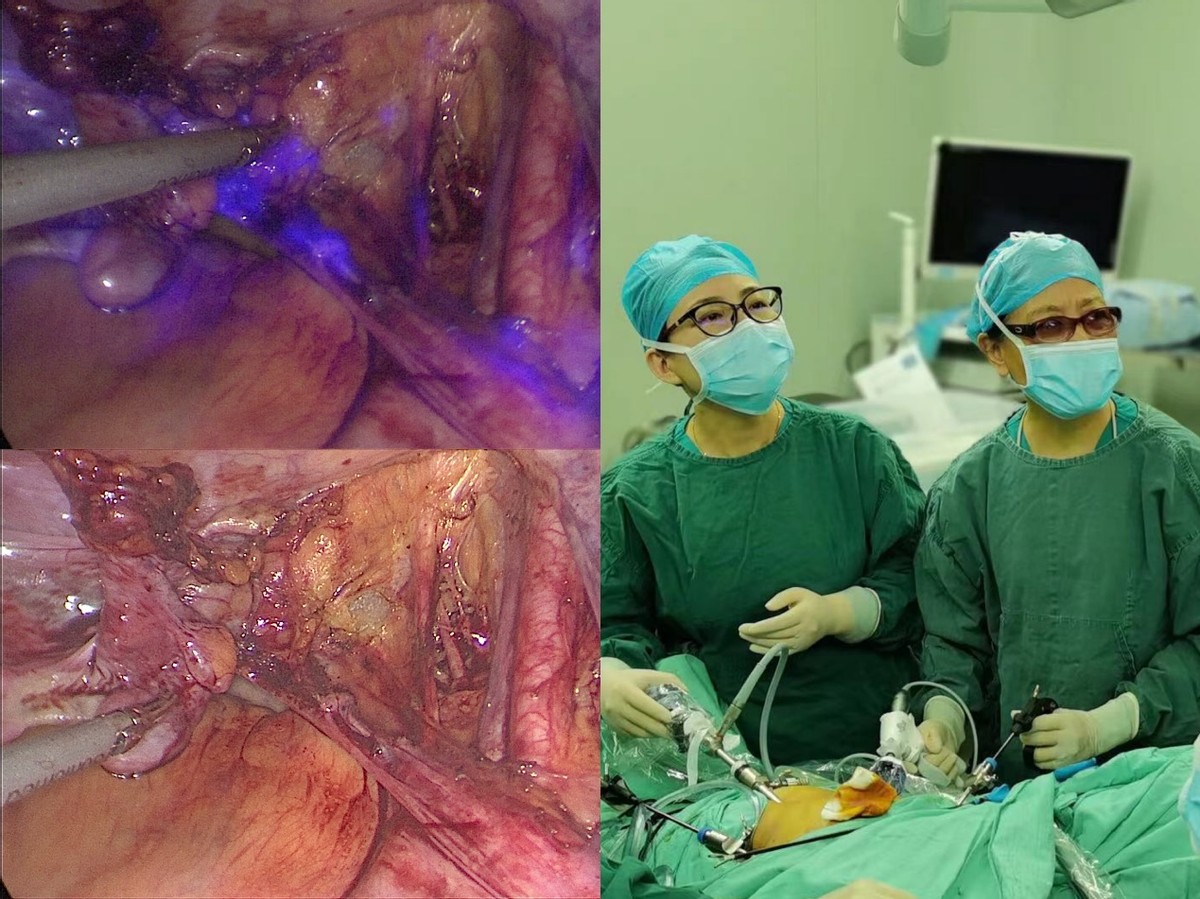 哈医大一院群力院区妇科团队荧光导航技术显著提高妇科恶性肿瘤切除精准度