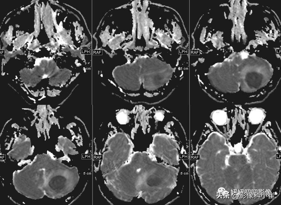 脑部局灶性强化是什么意思,脑部环形强化灶是什么意思
