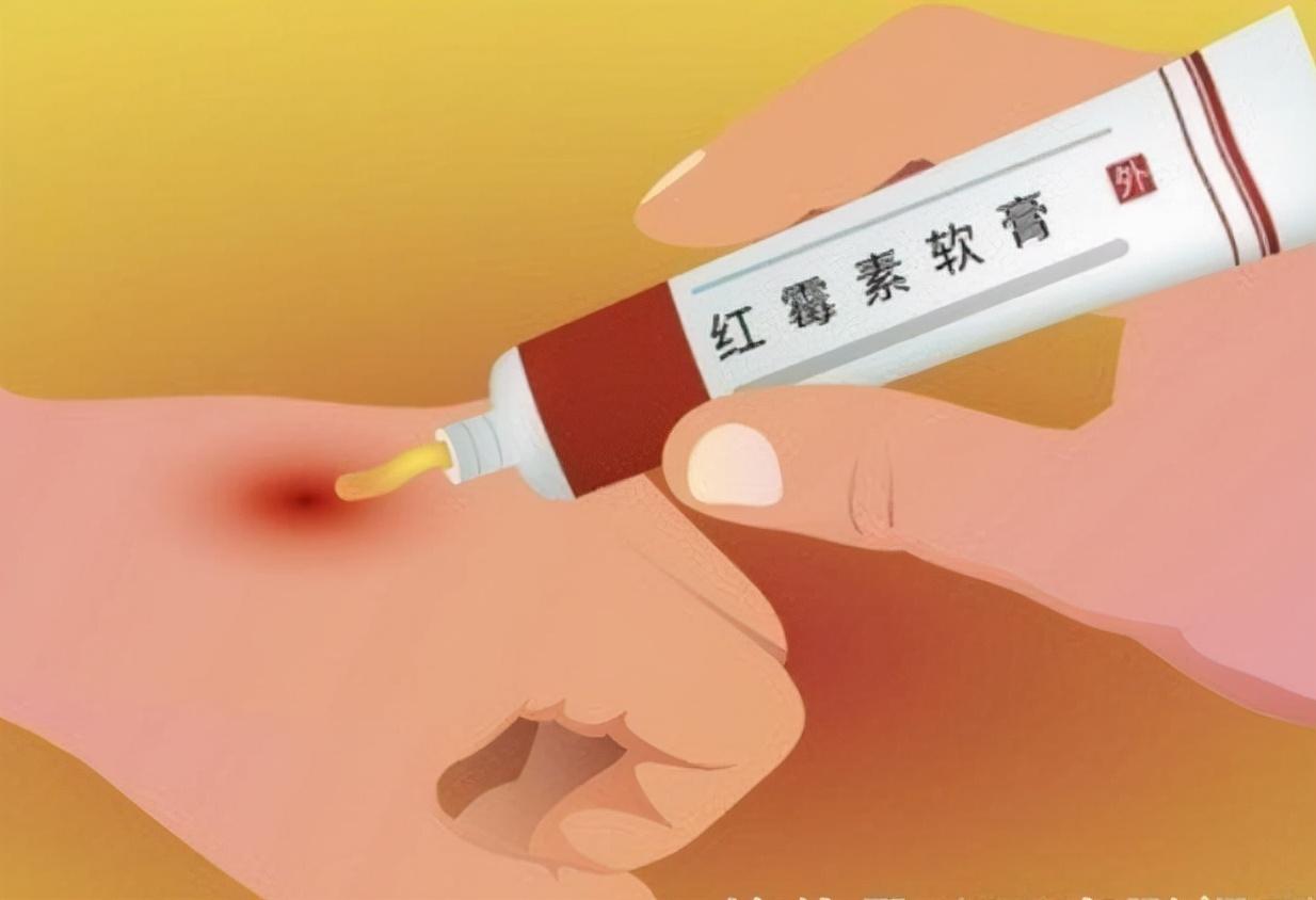 老年斑用红霉素软膏可以除掉吗,用红霉素眼药膏去除老年斑有效吗