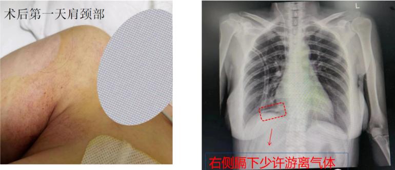 麻醉期间气道梗阻,手术后呼吸急促是什么原因