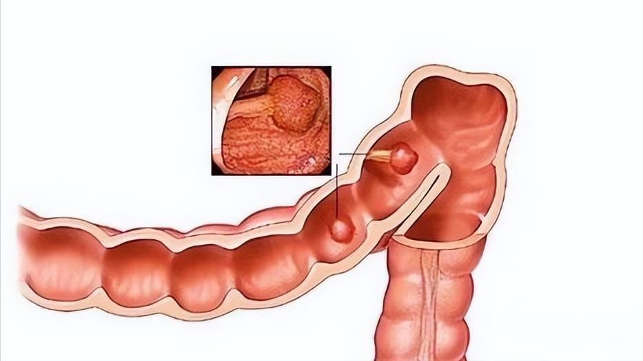 直肠癌的4个身体暗示需要警惕,直肠癌多半是拖出来的