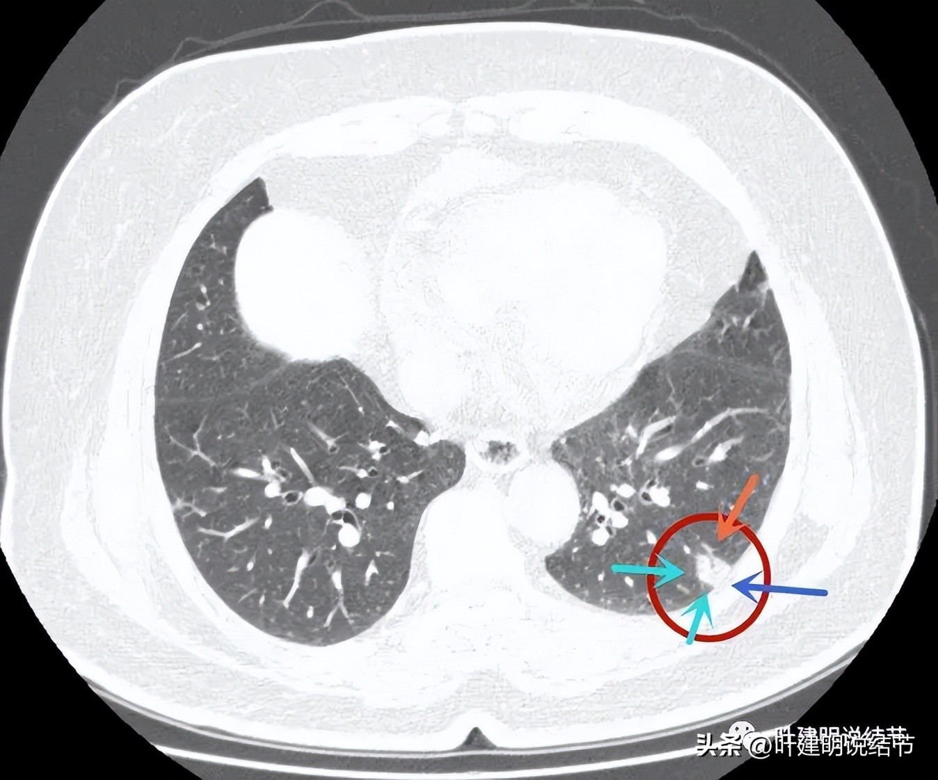 肺结节实性为什么建议抗炎治疗,肺上实性结节抗炎后变成空洞