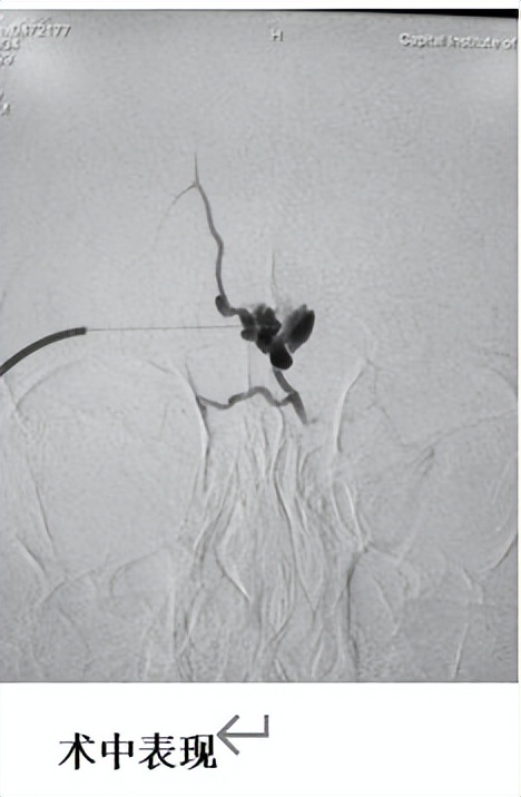 海绵状血管瘤手术头痛怎么回事,海绵状血管瘤3d手术