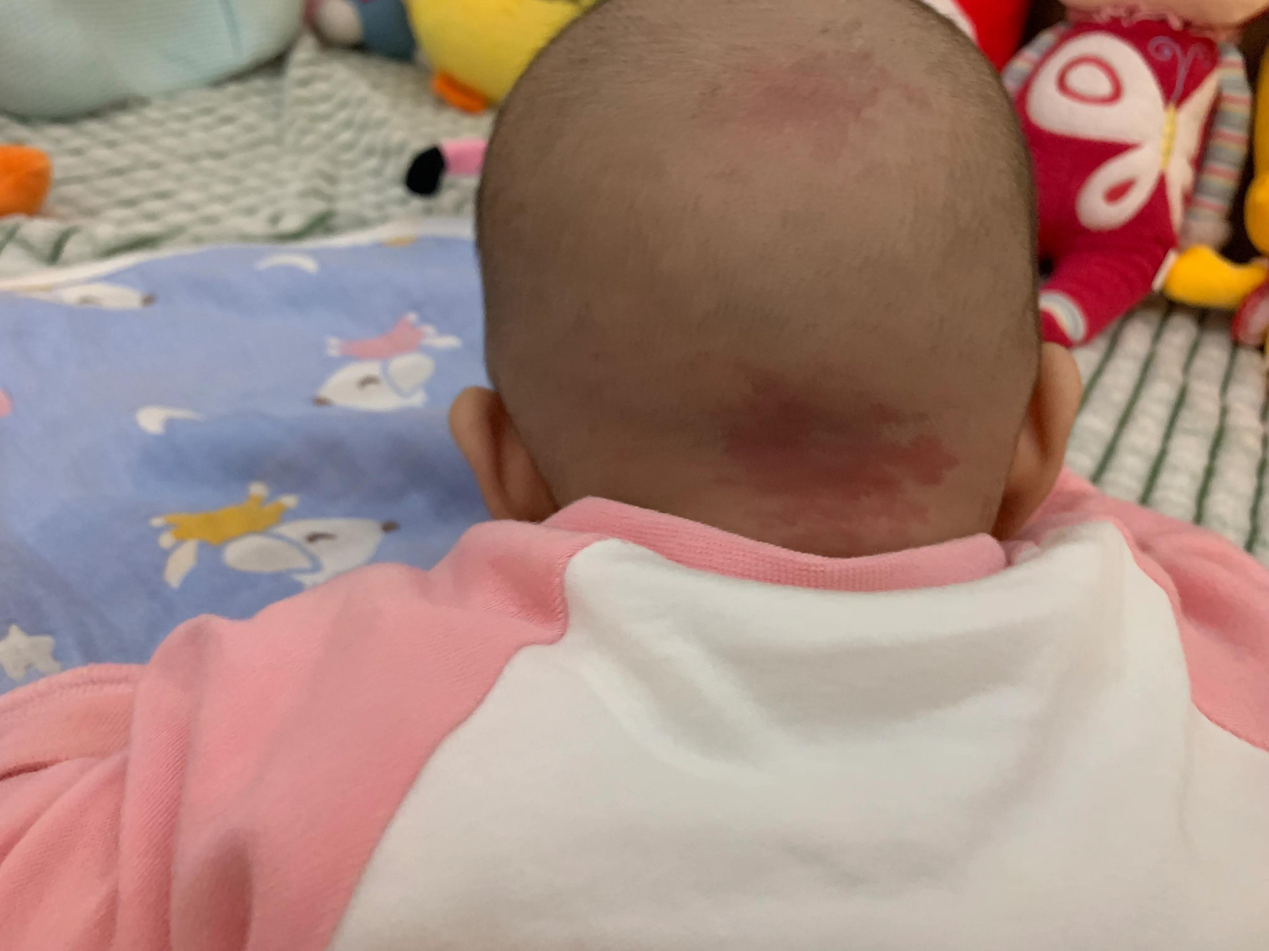 我家宝宝手上有胎记,宝宝身上有个胎记模糊不清