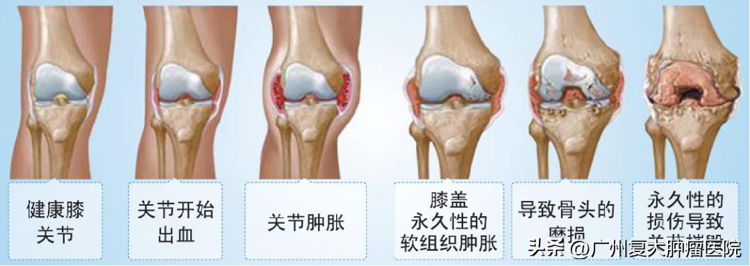 血友病关节出血超声表现,血友病关节超声表现