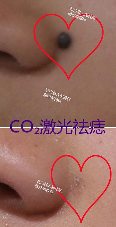 美丽无需“痣”疑！有痣别乱点，这些方法最靠谱