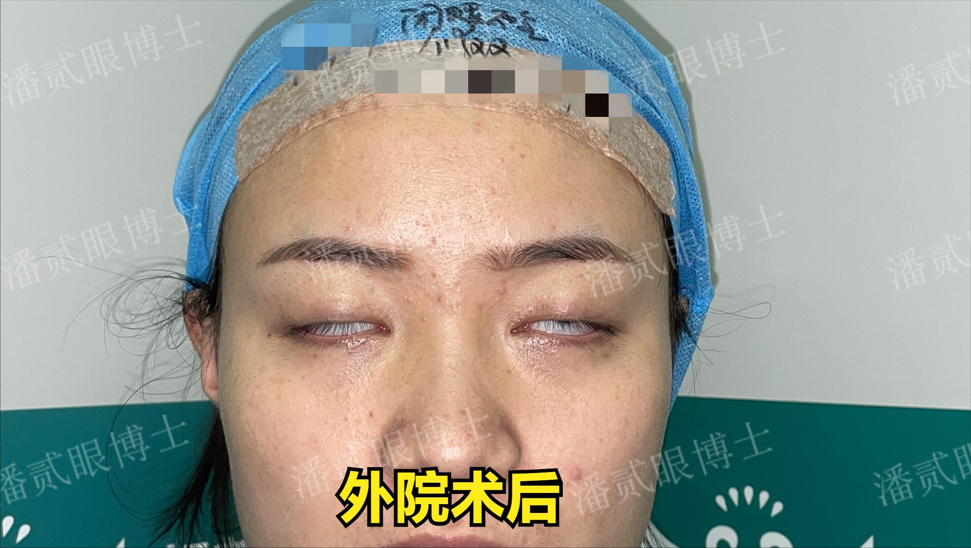 整容后眼睛不能闭合,整容失败眼睛无法闭合