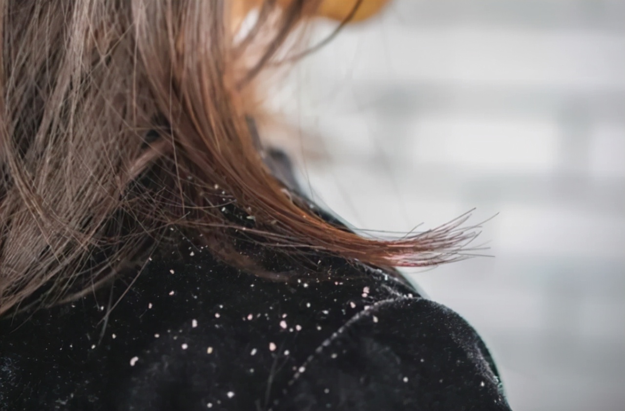 天天洗头还是很多头皮屑如何解决,天天洗头很多头皮屑什么原因