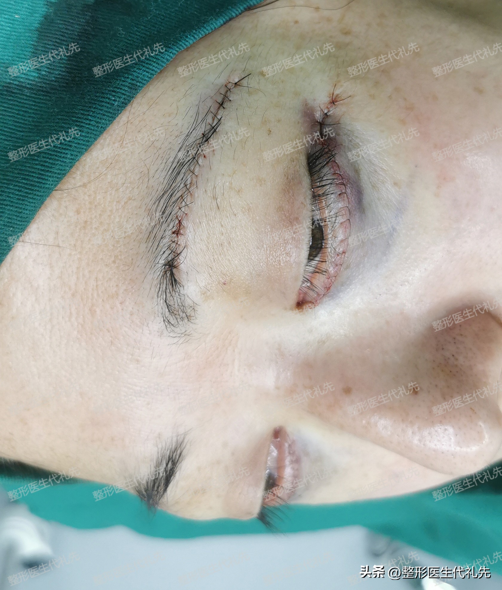 祛眼袋手术后凹陷多久恢复好,祛眼袋手术后眼眶处出现凹陷