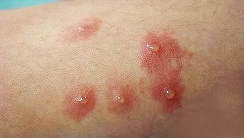 病毒性“性病”:尖锐湿疣「重组人干扰素α2b*剂喷**敷料」辅助治疗