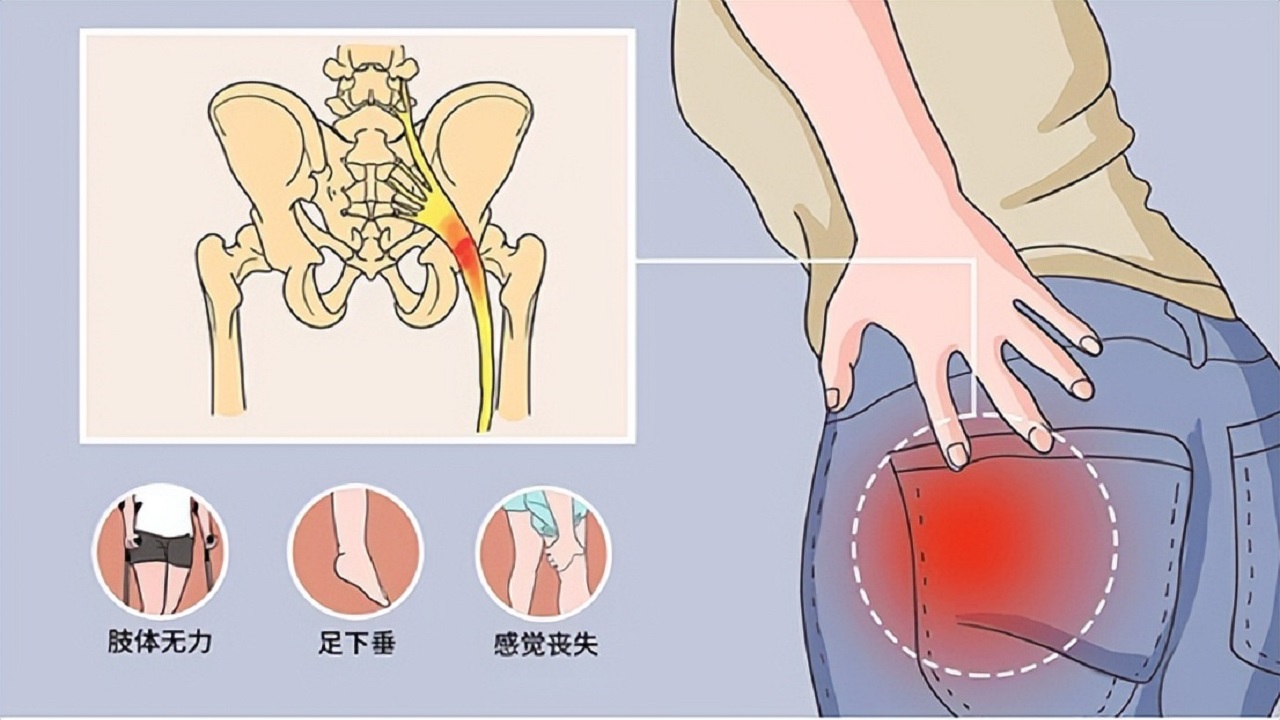 甲钴胺高血压可以吃么,甲钴胺片治疗腰椎突出好吗