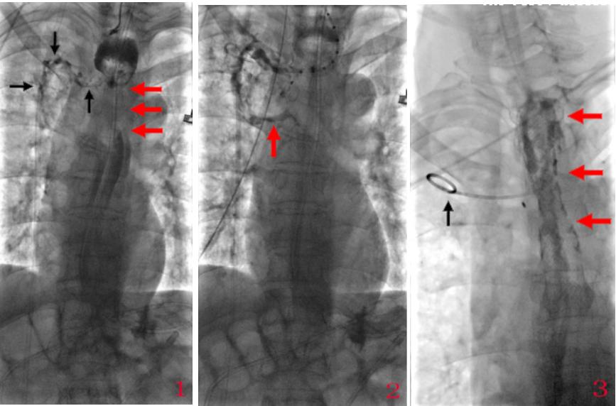 食管瘘介入治疗方法,食管瘘气管瘘的治疗成功率有多大
