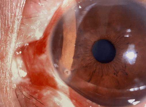 畏光流泪视物模糊,眼睛受伤后模糊有重影