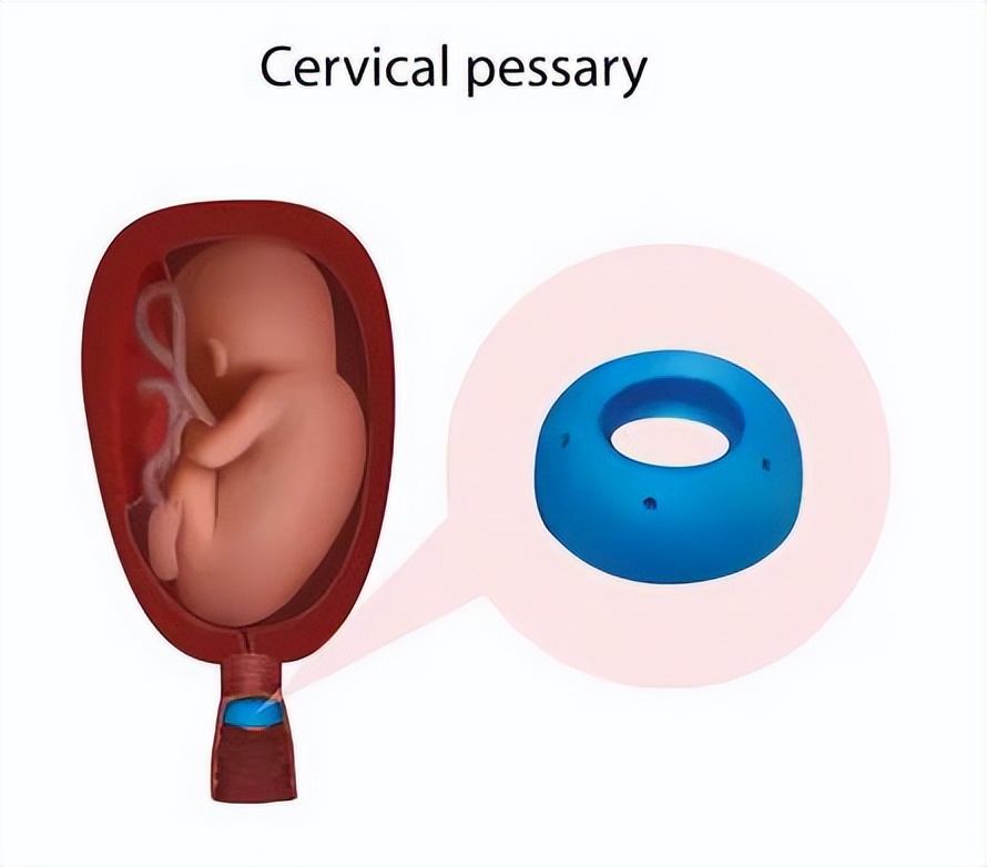 孕妈子宫“掉”到阴道口！备孕二胎，这件事一定要做
