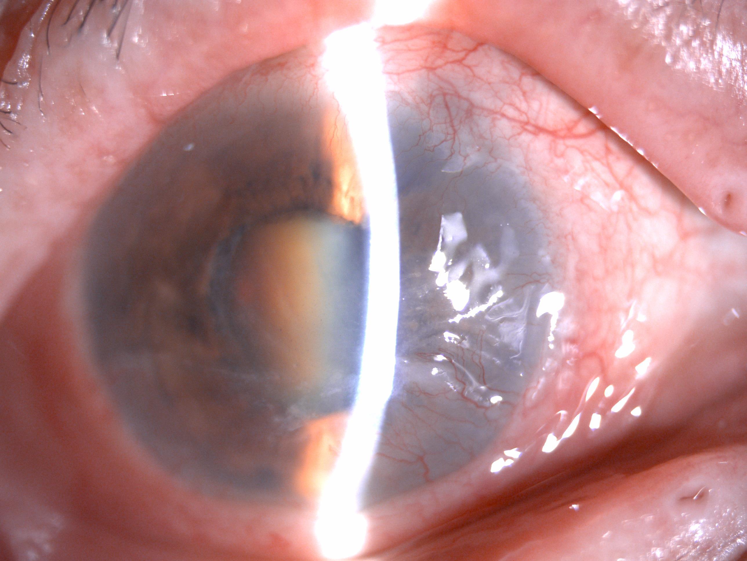 角膜不好还能做晶体植入吗,角膜不好能做近视手术吗