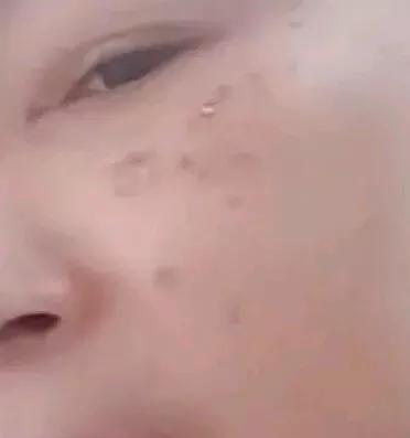 药水点斑有没有点好的呢,药水点斑的亲身经历