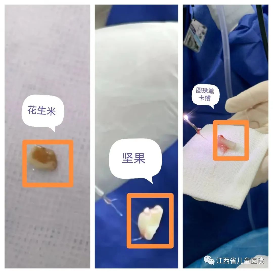 涨知识超简单,医院支气管镜取出异物多少钱