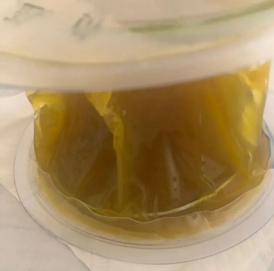 自闭症儿童粪菌移植最新进展,粪菌移植的自闭症女孩