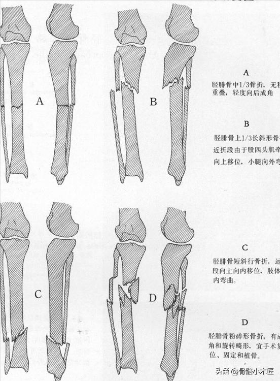 胫腓骨骨干骨折费用大概多少,胫腓骨骨干骨折是否构成伤残