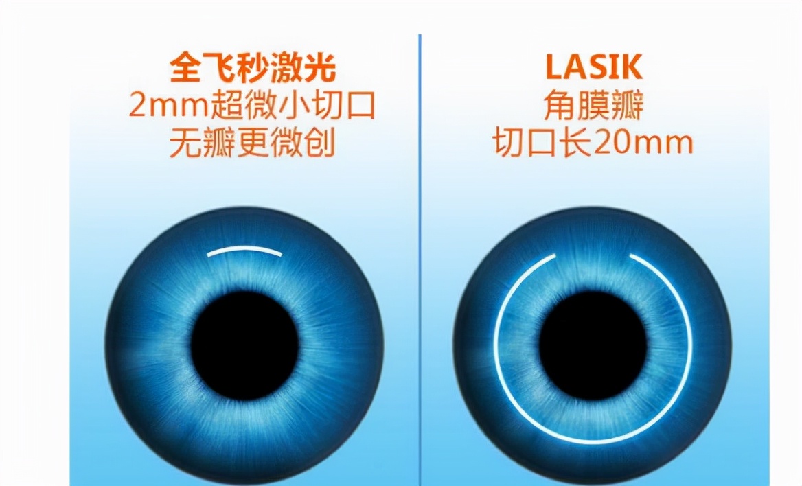 角膜激光手术矫正近视要多少钱,近视激光矫正手术的弊端与危害