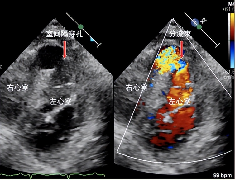 92岁老人心梗后室间隔穿孔四川大学华西医院心脏内科团队通过微创介入技术成功救治