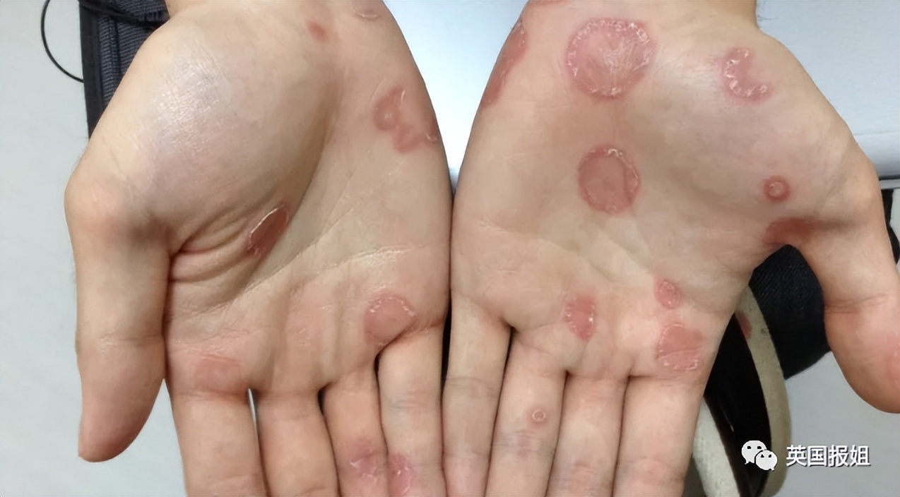 韩综艺男嘉宾被爆故意传性病给女友！纵容性产业导致梅毒患者激增