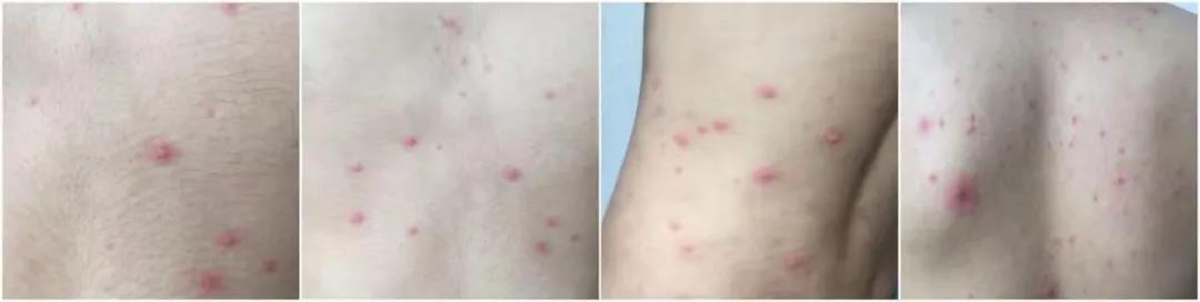 水痘科普标题,水痘科普类短视频