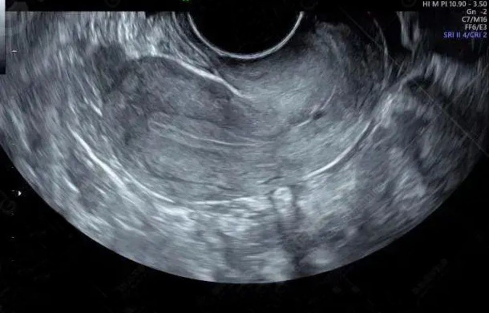 2015年，西安22岁女儿患绝症，43岁母亲舍命将子宫移植给女儿圆梦