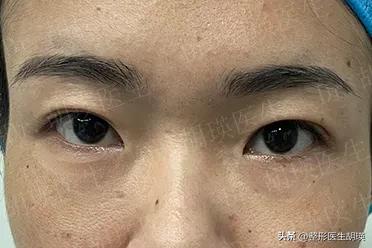 埋线双眼皮眼部淤青很厉害怎么办,埋线双眼皮没有那么明显了怎么办