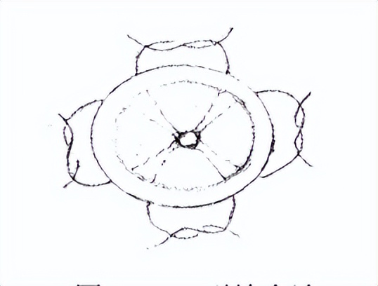 派特灵派特生物科普｜冷刀宫颈锥切术操作步骤和注意事项