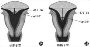 「临床」关于女性生殖器官畸形的那些事