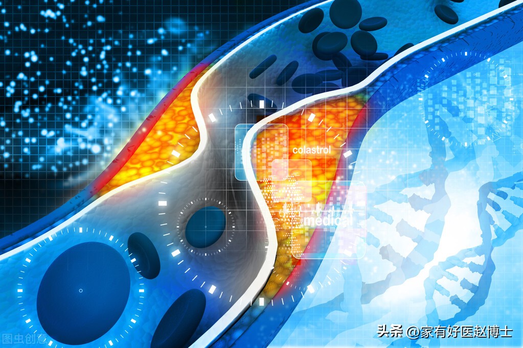 有动脉斑块必须要吃阿司匹林多久,有颈动脉斑块吃阿司匹林可以吗