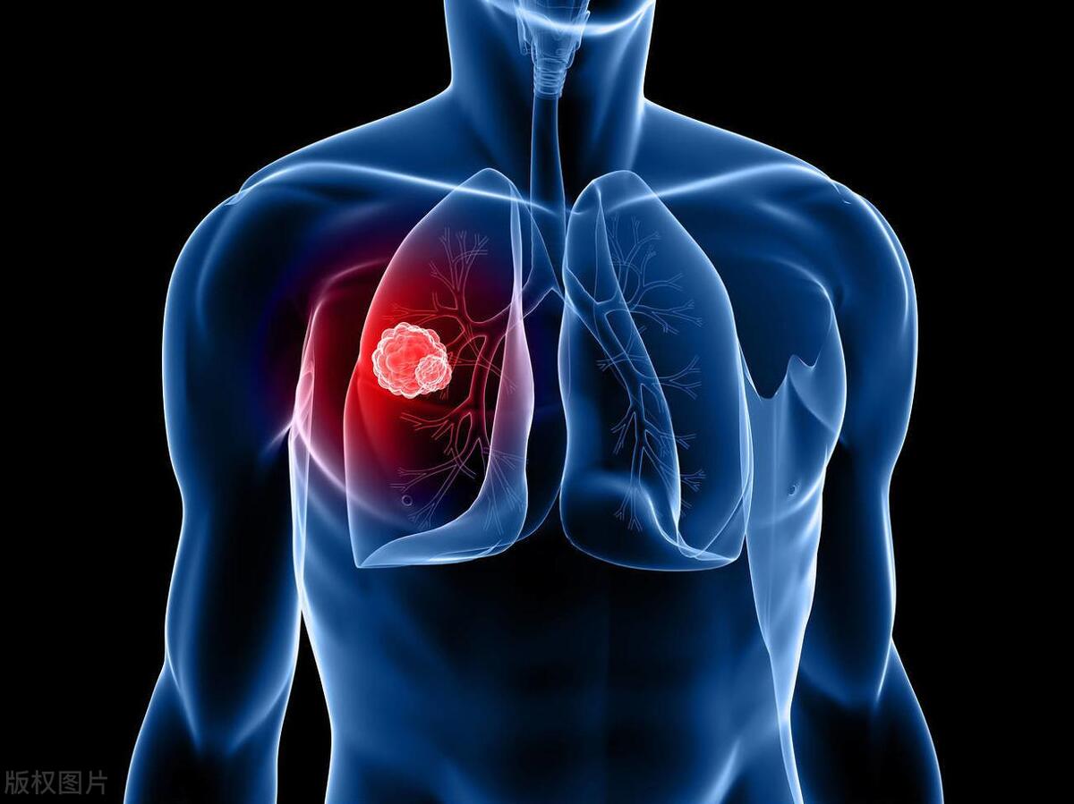 得了肺癌还能活多久取决于3点,人得了肺癌大概还能活多久