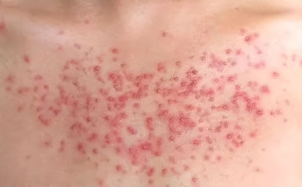 汗斑跟痱子怎么区分,汗斑传染给小孩子吗