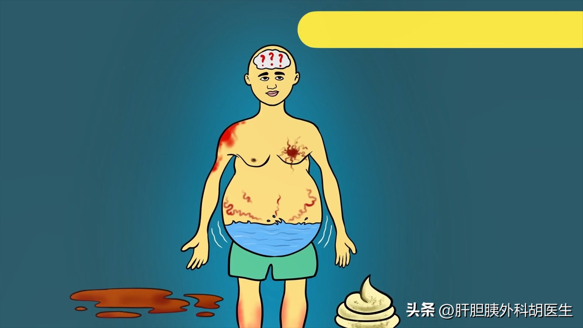 肝腹水肝硬化晚期症状表现有哪些,小孩肝硬化表现症状