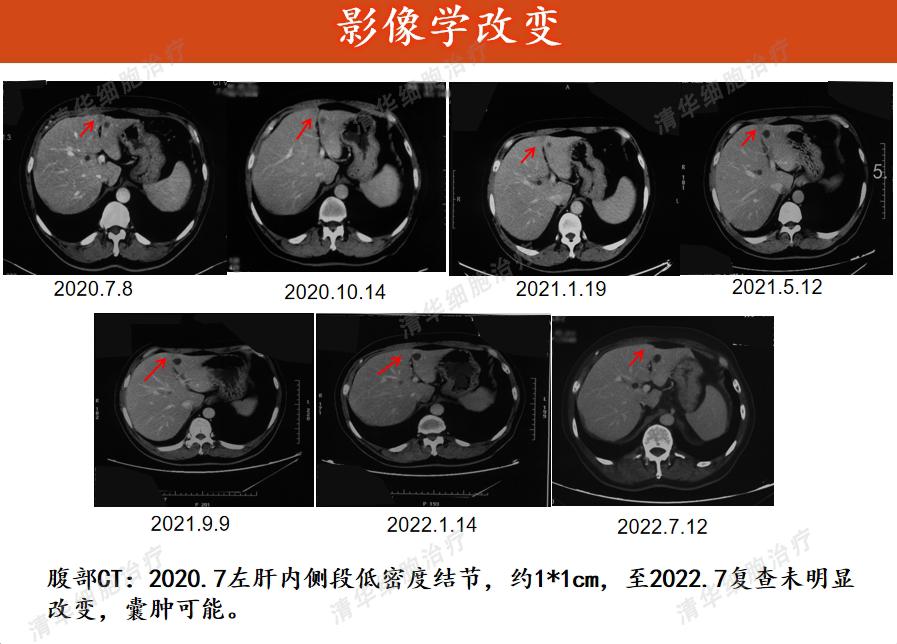 膀胱癌，两年内3次手术2次化疗，怎样才能彻底解决问题
