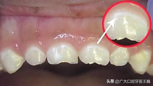 隐形牙套上面有白点,牙套上的白点是什么