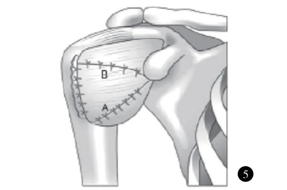 肩关节不稳定患者提问,肩关节习惯性脱臼不治疗的后果