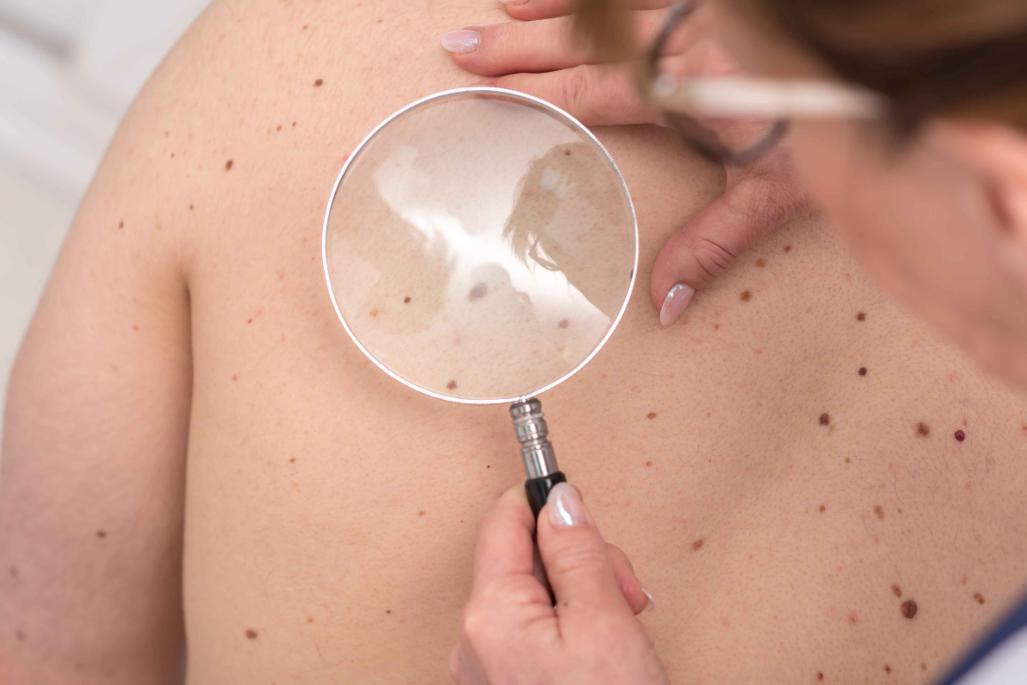 这8个部位长痣或是癌症前兆,痣长在身体这8个部位要小心癌症