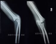 肱骨骨折取钢板怎样恢复,肱骨近端骨折切开复位内固定术